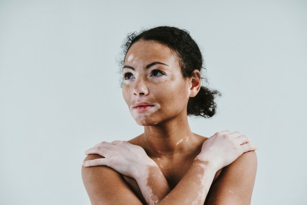 vitiligo peau femme