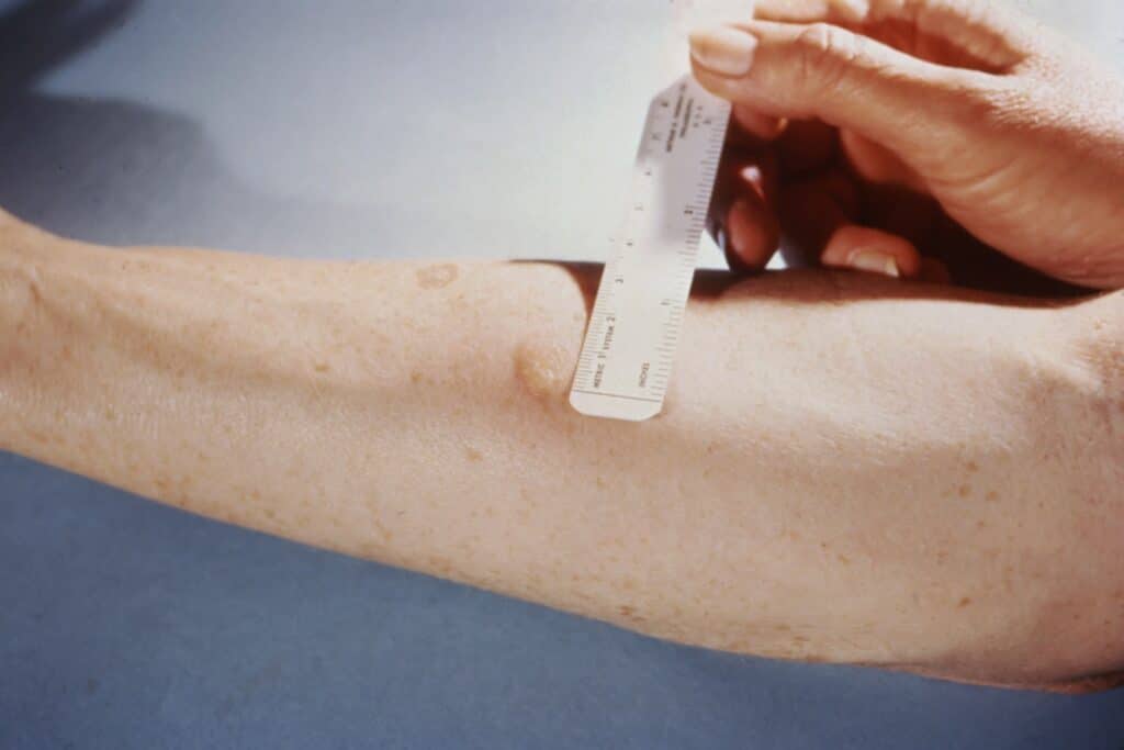 This patient presented with a positive reaction to the 48-hour Mantoux skin test. The Mantoux skin test is given with a needle and syringe, used to inject testing fluid, called tuberculin, between the layers of the skin, usually on the volar surface of the forearm, as was the case here. The injection site becomes hard, or indurated, and red, in a person who is infected with tuberculosis.