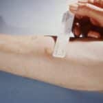 This patient presented with a positive reaction to the 48-hour Mantoux skin test. The Mantoux skin test is given with a needle and syringe, used to inject testing fluid, called tuberculin, between the layers of the skin, usually on the volar surface of the forearm, as was the case here. The injection site becomes hard, or indurated, and red, in a person who is infected with tuberculosis.